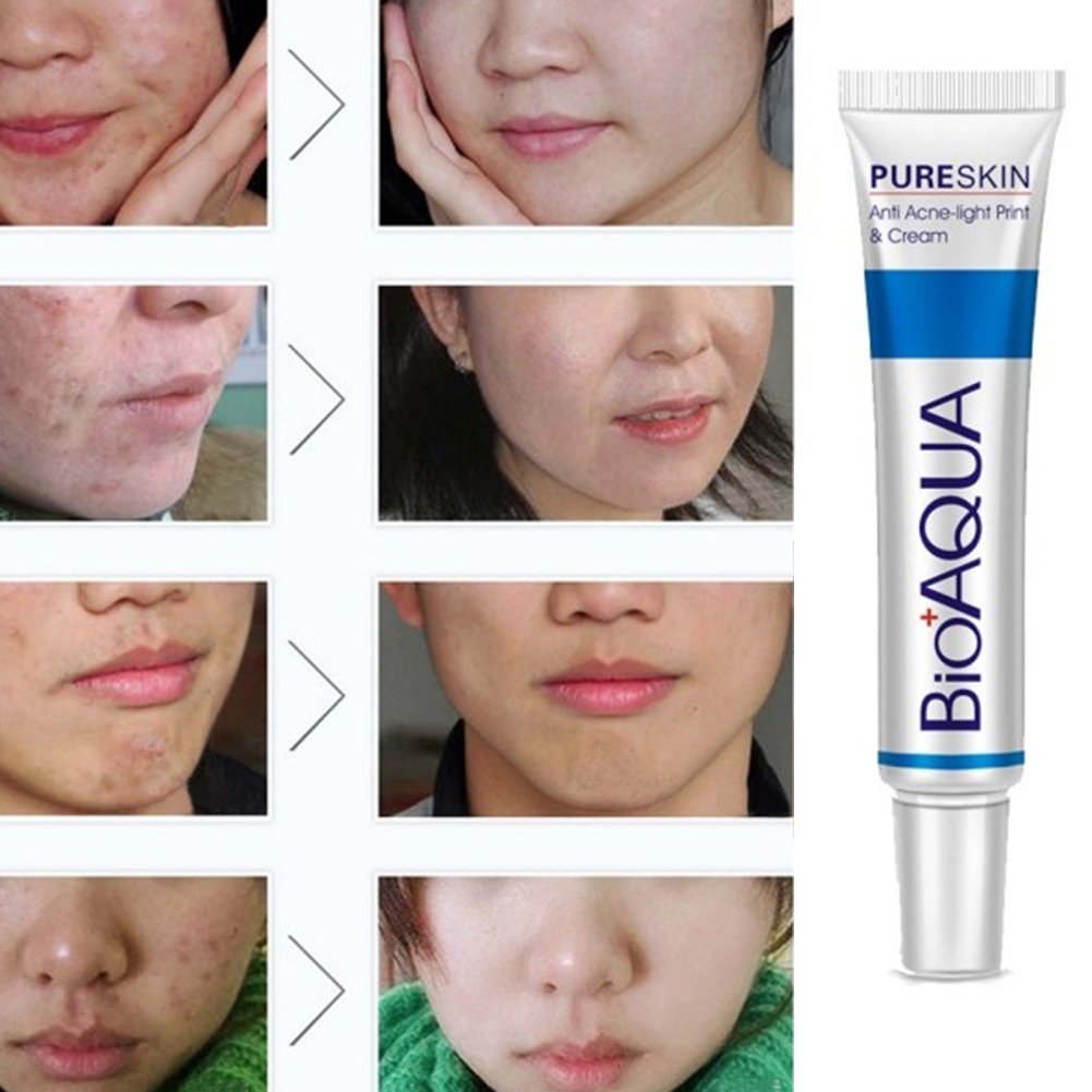 Crema Facial Antiacné Profesional